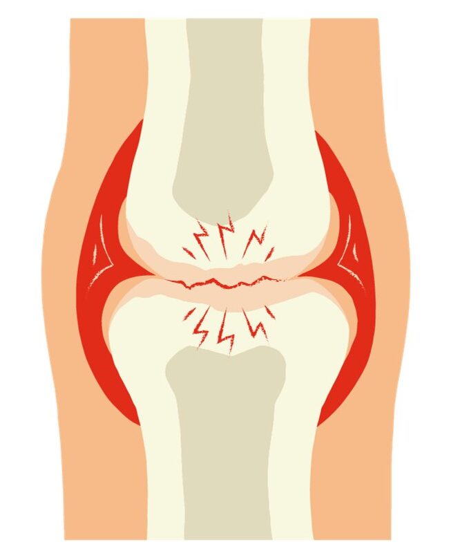 Une illustration d'un membre souffrant d'arthrose.